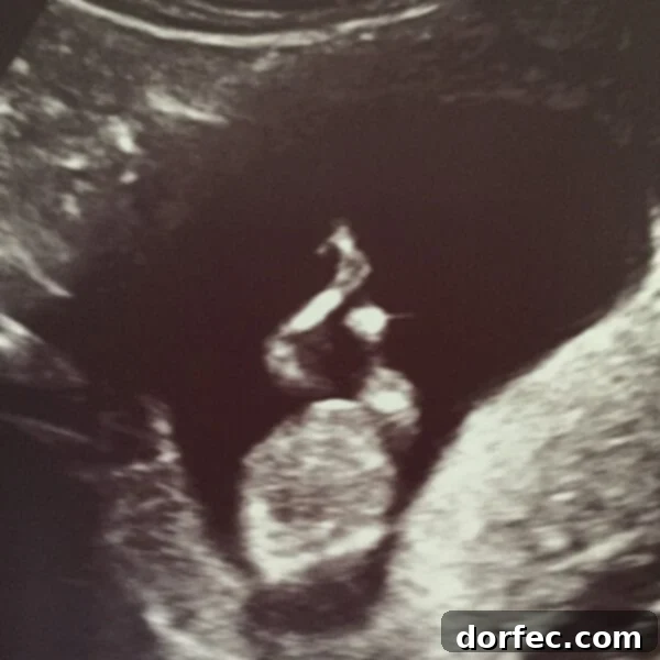 Hyperemesis: Turning the Corner to Wellness 4 Excitement Builds: Baby Update and Gender Reveal