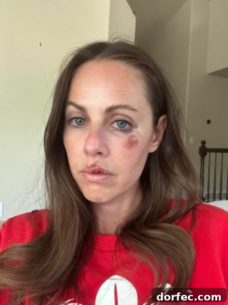 A close-up of injuries sustained during a bicycle accident, highlighting the need for helmet safety.